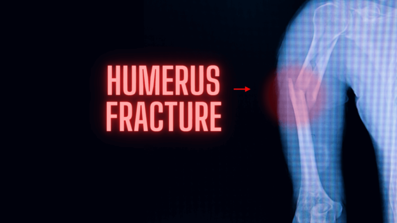 Humerus Surgery | Humerus Fracture | Recovery & Surgery